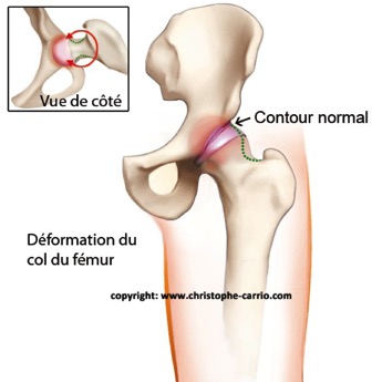 carrio-conflit-hanche-cote