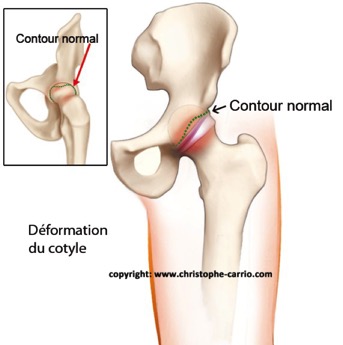 carrio-articulation-hanche-contour-normal