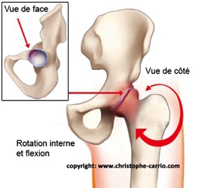 carrio-conflit-hanche-face